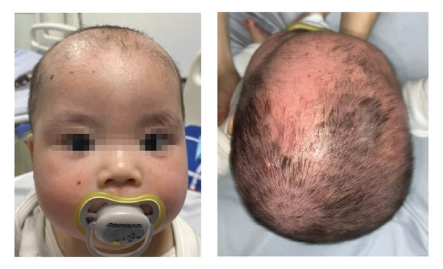 Hình ảnh của trẻ sau 4 ngày điều trị Bệnh viện Da liễu Trung ương da-dau1.jpg