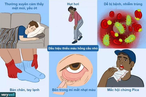 Các biểu hiện của thiếu máu - Ảnh minh họa hoi-chung-thieu-mau.jpg