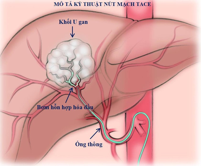 Điều trị ung thư gan bằng kỹ thuật TACE dưới hướng dẫn máy chụp mạch số hóa xóa nền DSA - Hình ảnh mô tả kỹ thuật nút mạch TACE tace-1.jpg