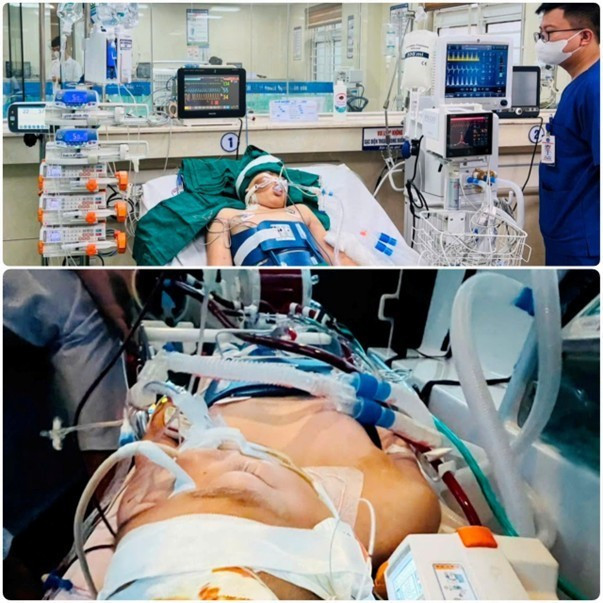 Bệnh nhân dị dạng động tĩnh mạch những ngày hồi sức tích cực - Ảnh BVCC anh-1.jpg
