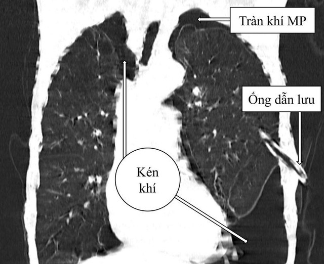 Hình ảnh kén khí phổi trên phim cắt lớp vi tính của người bệnh - Ảnh BVCC ken-pphoi.jpg