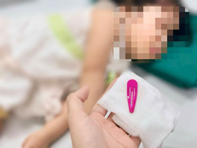 Dị vật là chiếc kẹp tóc đã được lấy ra thành công - Ảnh BVCC kep-toc-1.jpg