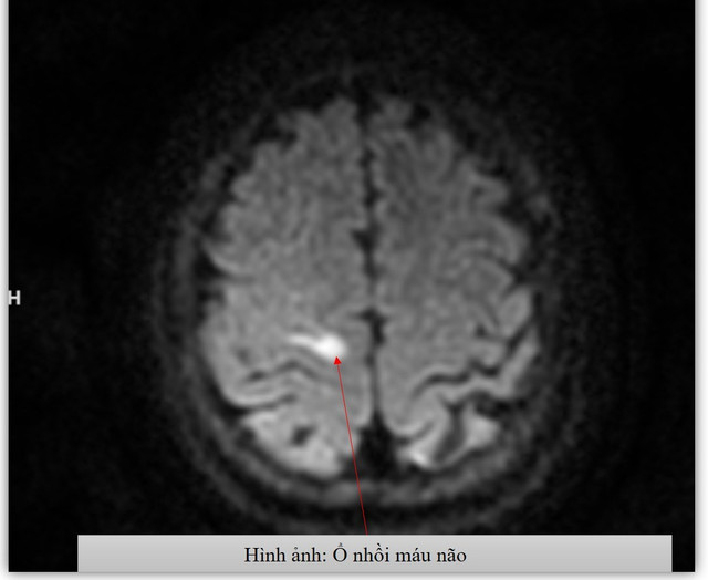 Kết quả chụp MRI - Ảnh BVCC mach-mau-nao-my3.jpg