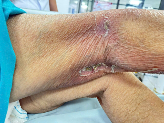 Vết ong đốt mưng mủ ở bệnh nhân - Ảnh BSCC ong-dot.jpg