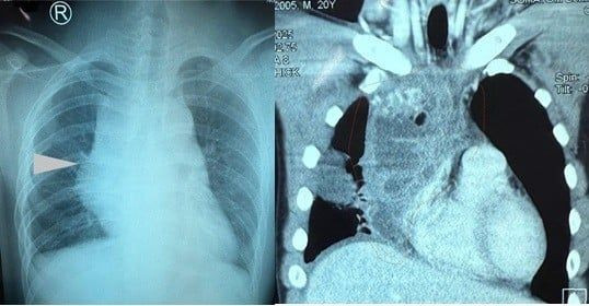 Kết quả chụp X - quang u trung thất khổng lồ - Ảnh BVCC u-quai.jpg