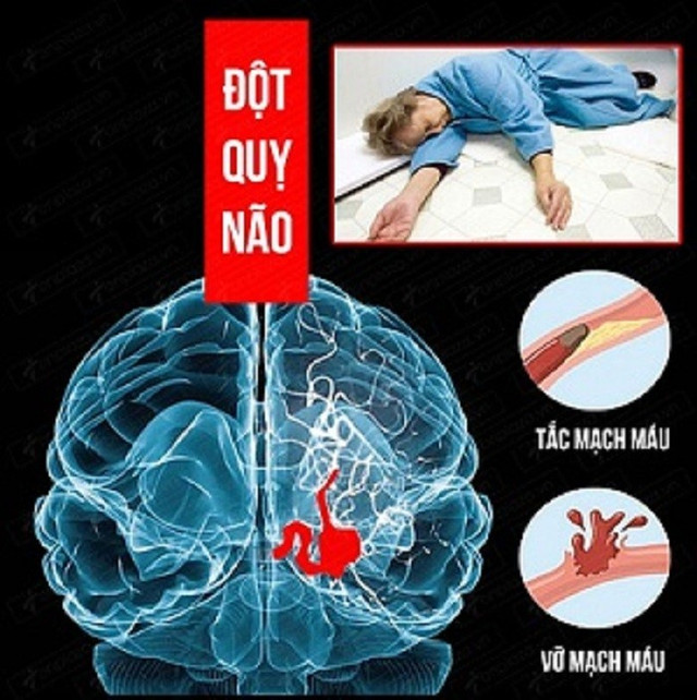 Nguyên nhân gây đột quỵ não - Ảnh minh họa nguồn Internet dot-quy-nao-1.jpg