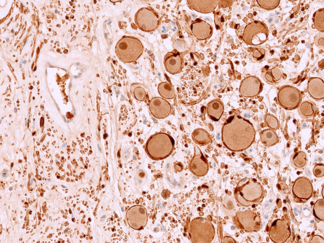Biểu hiện tế bào của u nguyên bào thần kinh Ganglioneuroblastoma - Ảnh BVCC kham-soi-1.jpg