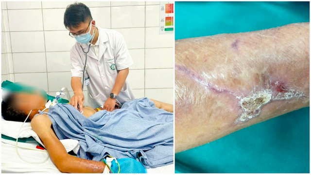 Bệnh nhân nam thợ xây bị uốn ván do ngã đập tay vào tấm gỗ để vết thương khoảng 15 cm - Ảnh BVCC uon-van-cay-2.png
