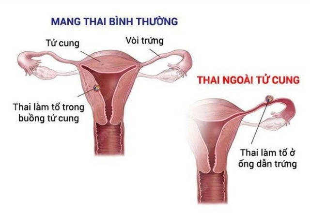 Biểu hiện thai ngoài tử cung - Ảnh minh họa nguồn Internet thai-ngoai-tu-cung.jpg