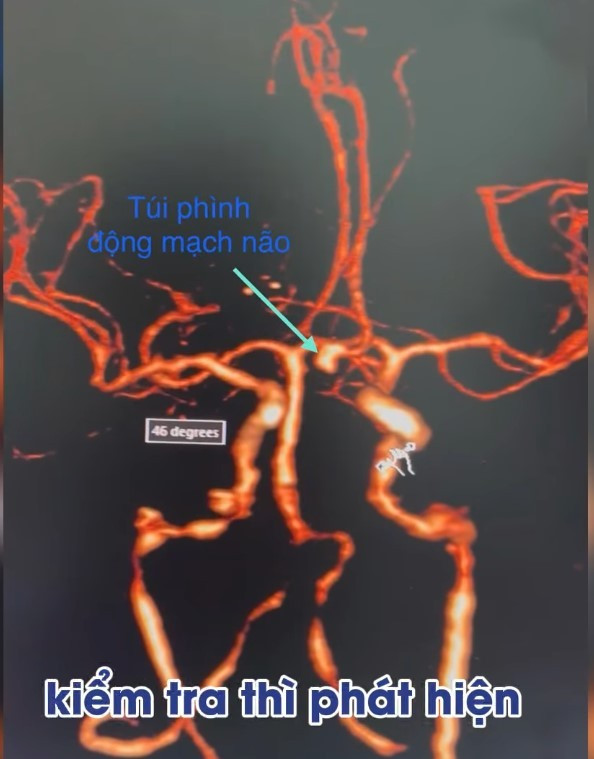 Túi phình động mạch não của bệnh nhân - Ảnh BVCC tui-phinh.jpg