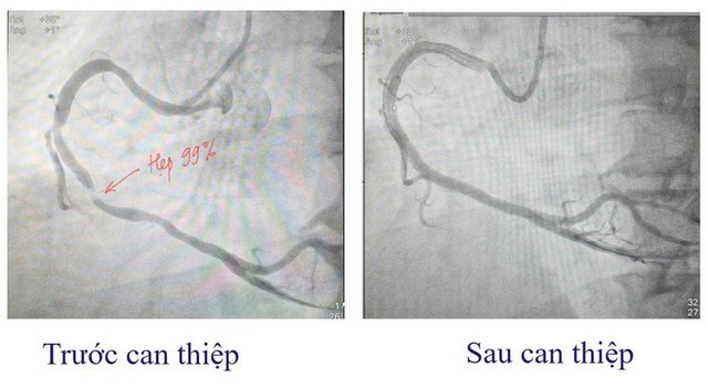 Hình ảnh mạch máu trước và sau can thiệp - Ảnh BVCC nhoi-mau-st1.jpg