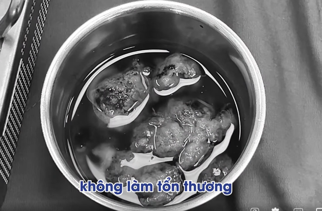 Khối u màng não được lấy bỏ - Ảnh cắt từ video bệnh viện u-nao-to.png