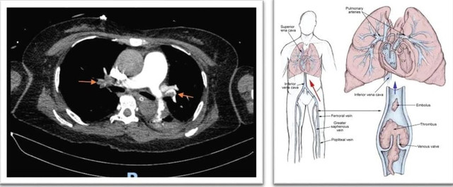 Kết quả CT-scan khẳng định thuyên tắc phổi cấp, do huyết khối từ tĩnh mạch sâu chân (T) di chuyển lên - Ảnh BVCC cr-1.jpg