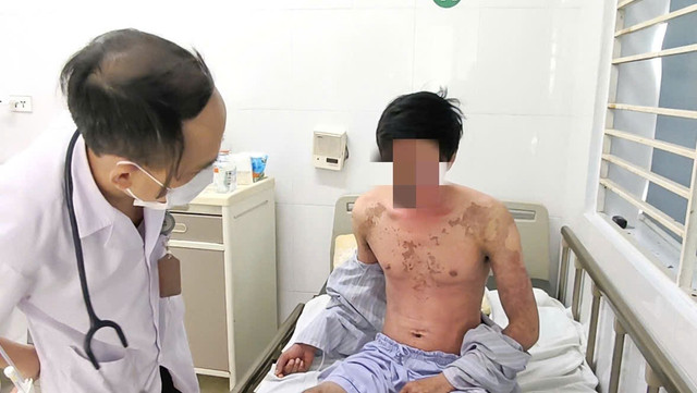 Bỏng rát toàn thân, mù tạm thời vì silicon chống dột - Ảnh BVCC bong-rat.jpg