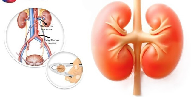 Hội chứng kẹp hạt dẻ - Ảnh BVCC hoi-chung-kep-hai-de.jpg