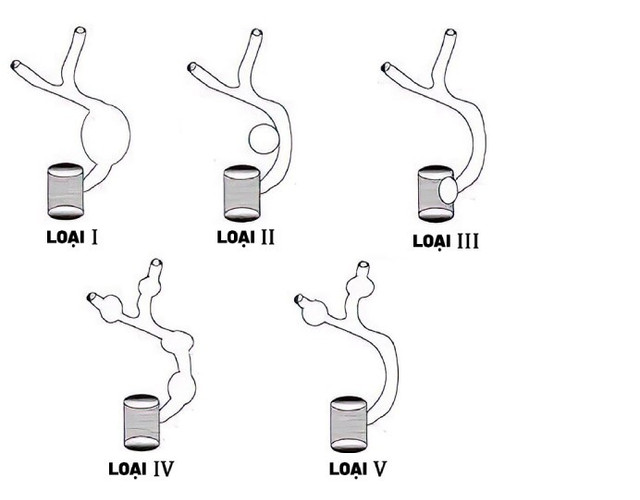 Các cấp độ u nang ống mật chủ - Ảnh minh họa 5-loai-nang-ong-mat-chu.jpg