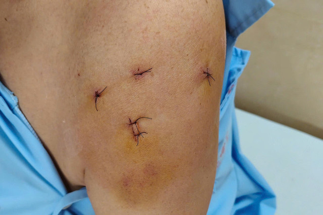 Vết thương sau phẫu thuật - Ảnh BVCC khai-chop-vai-4.jpg