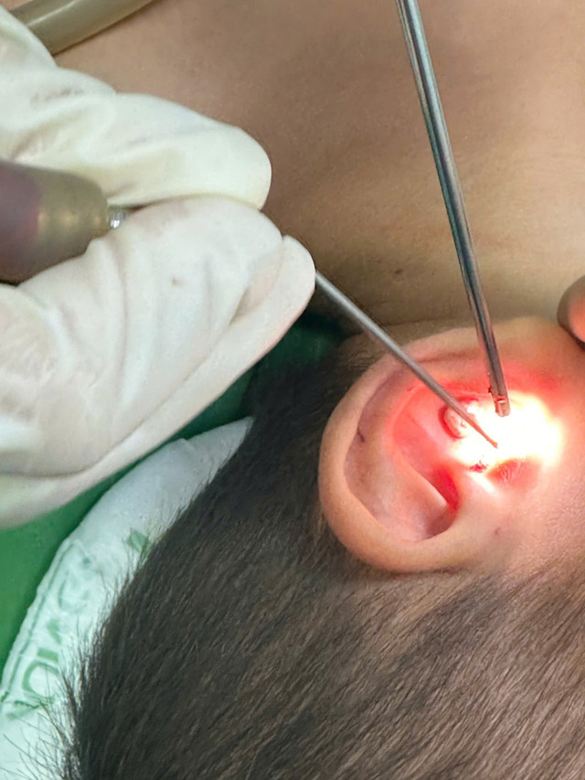 Nội soi gây mê lấy dị vật tai cho trẻ - Ảnh BVCC soi-tai-2.jpg