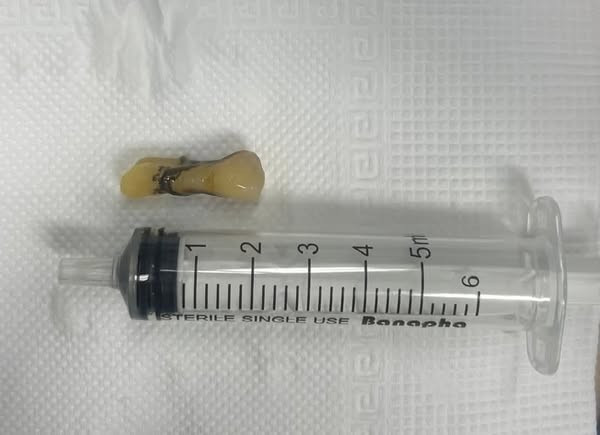 Chiếc răng được lấy ra từ phế quản gốc của bệnh nhân - Ảnh BVCC rang-phe-quan.jpg
