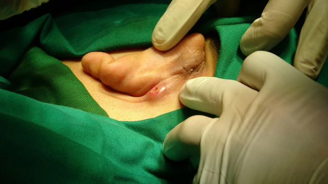 Hình ảnh trước khi phẫu thuật - Ảnh BVCC vanh-tai.jpg