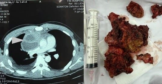 Hình ảnh khối u trên phim chụp và sau khi được cắt bỏ - Ảnh BVCC u-qiau-1.jpg