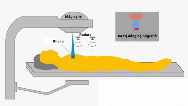 Quy trình mô phỏng xạ trị đồng bộ nhịp thở, chỉ phát tia khi u vào đúng vị trí. xa-tri-dong-bo-nhip-tho.jpg