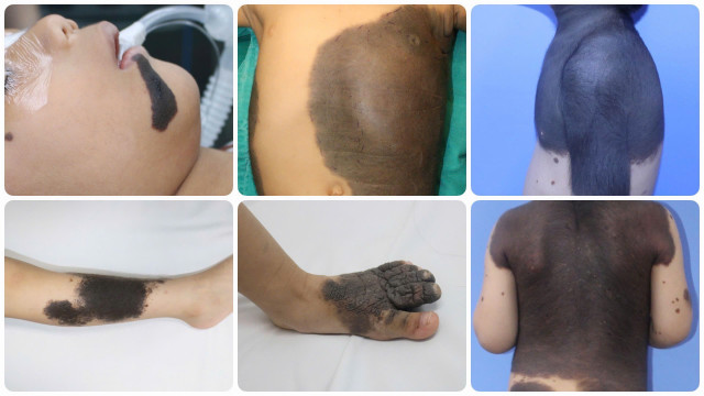 Nơ vi hắc tố gây ung thư da xuất hiện nhiều nơi trên cơ thể - Ảnh BVCC dom-mau-3.jpg