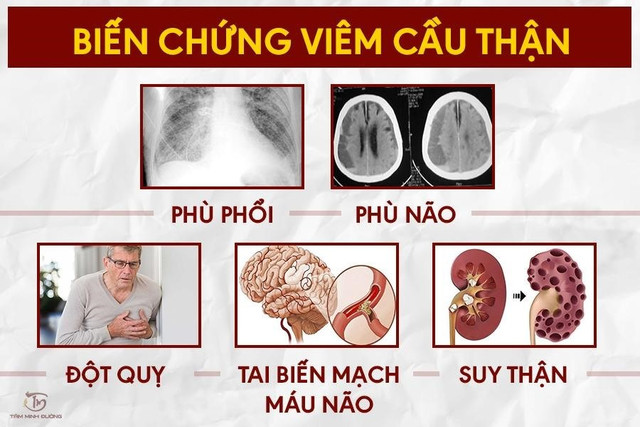 Biến chứng viêm cầu thận - Ảnh minh họa nguồn Internet bien-chung-viem-cau-than.jpg
