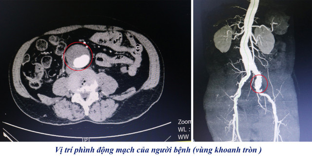 phinh-dong-mach-bung-2.jpg