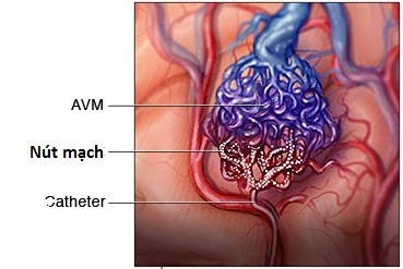 Dị dạng mạch máu được nút mạch - Ảnh minh họa dieu-tri-avm-bang-nut-mach.jpg