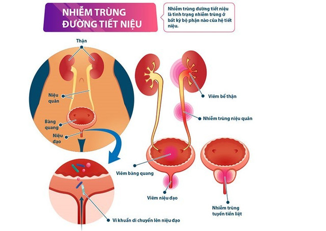 Các cơ quan bị bệnh do nhiễm trùng đường tiết niệu - Ảnh minh họa nguồn Internet nhiem-khuan-duong-tiet-nieu-6666.jpg