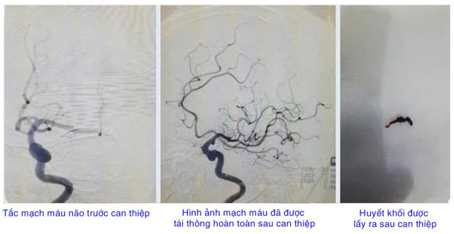 Hình ảnh phim chụp của cụ bà 92 tuổi - Ảnh bvcc dot-quy-3.jpg