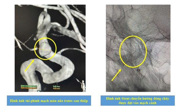 Ca can thiệp thành công dị dạng mạch máu não chưa vỡ bằng kỹ thuật đặt stent chuyển dòng. phinh-mach-mau-nao-1.jpg