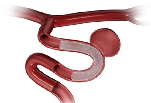 Hình ảnh minh họa stent chuyển dòng chắn ngang túi phình, đảo hướng dòng chảy giúp triệt tiêu túi phình sau một thời gian - Ảnh BVCC phinh-mach-mau-nao-3.jpg