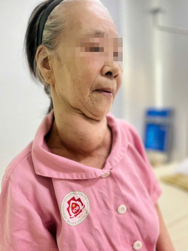 Bệnh nhân 71 tuổi với khối u tuyến giáp khổng lồ. buou-giap.jpg