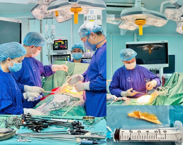 Ca phẫu thuật cho bệnh nhân - Ảnh BVCC thung-ruot-3-9269.jpg