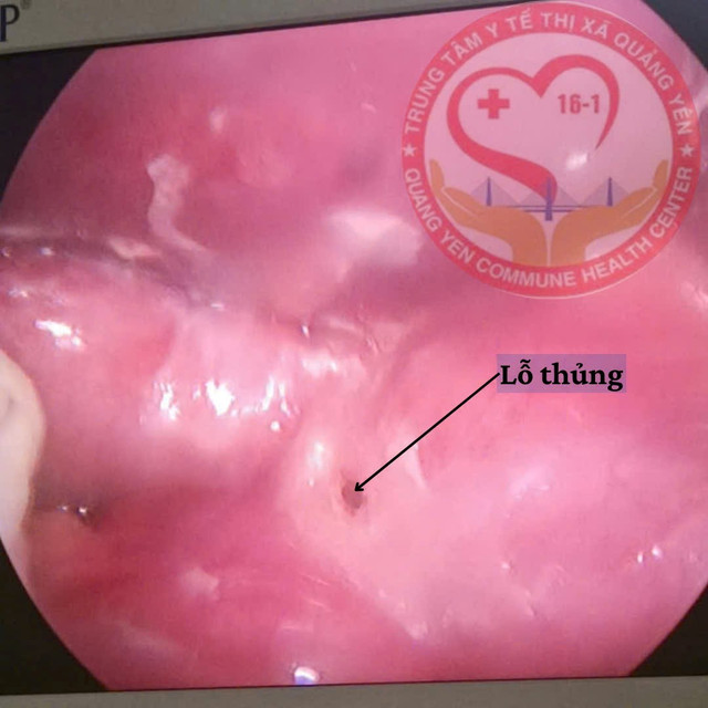 Lỗ thủng trên hình ảnh nội soi - Ảnh BVCC thung-tang-1.jpg