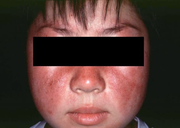 Dấu hiệu bệnh lupus ban đỏ thể hiện trên mặt - Ảnh BVCC lupt-t.jpg