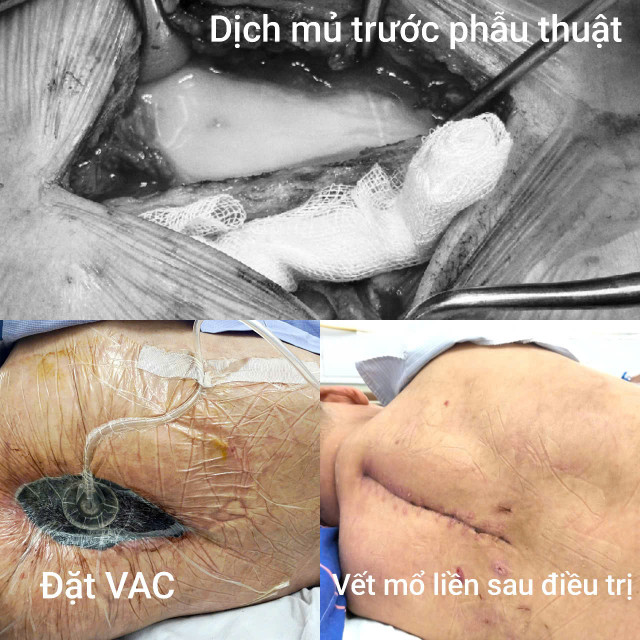 Vết mổ đã lành sau 14 ngày điều trị tích cực - Ảnh BVCC nhiem-nam-4.jpg