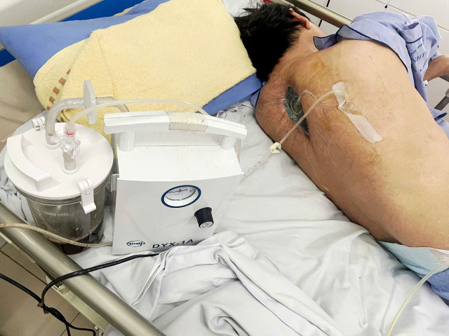 Đặt hệ thống VAC để làm lành vết thương. nhiem-nam-1.jpg