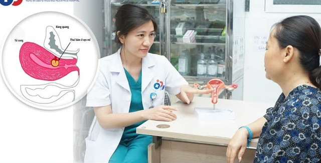 Tư vấn cho bệnh nhân mang thai trên sẹo mổ - Ảnh BVCC giu-tu-cung.jpg