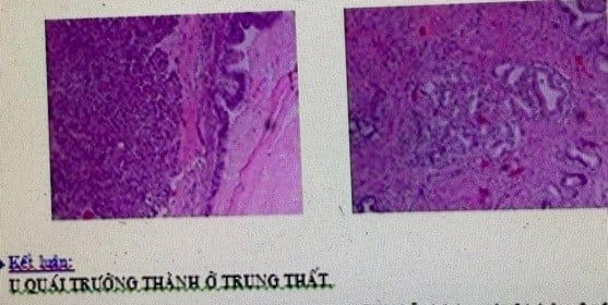 Kết quả giải phẫu bệnh là u quái trưởng thành - Ảnh BVCC u-quai-2.jpg