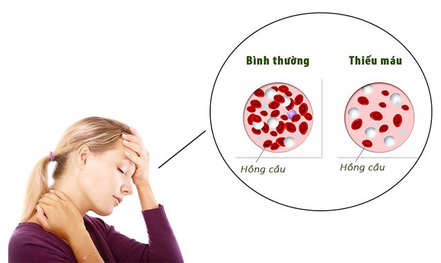 Biểu hiện của ung thư máu - Ảnh BSCC huyet-hoc.jpg