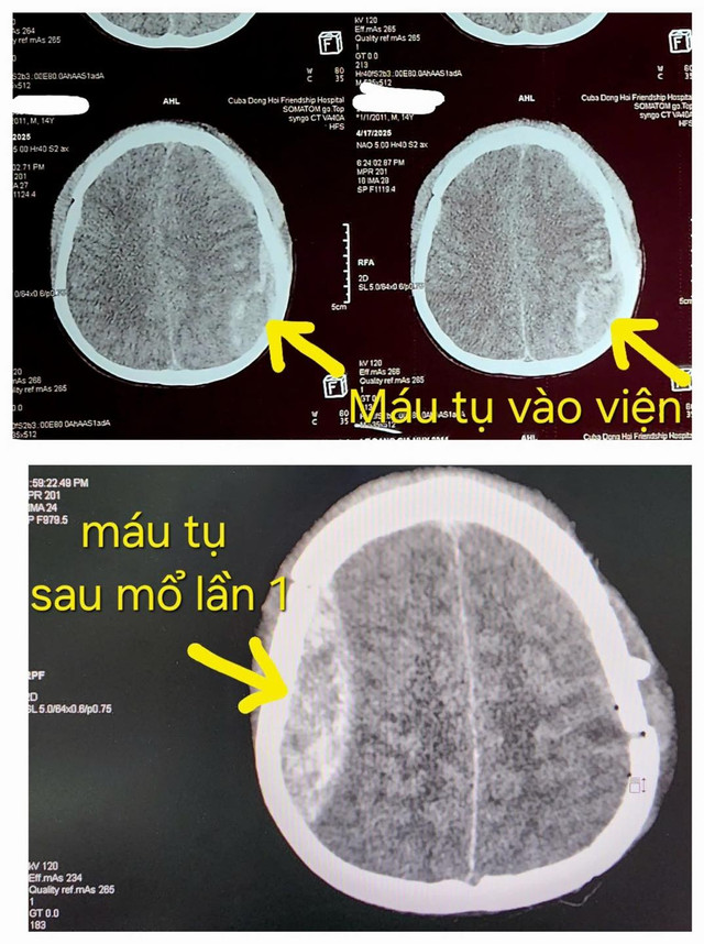 Máu tụ ca phẫu thuật lần 1 - Ảnh BVCC 2-lan-mo-nao-1.jpg