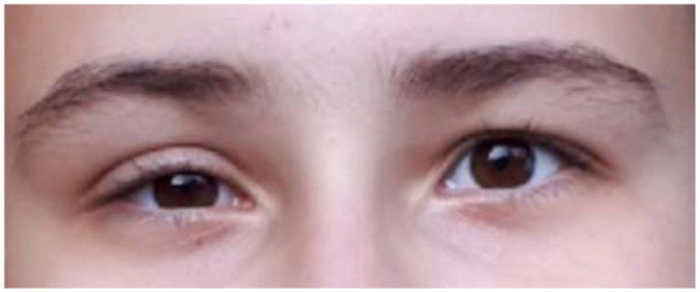 Sụp mi mắt có liên quan đến mổ tuyến giáp - Ảnh BSCC sup-mi-mat.jpg