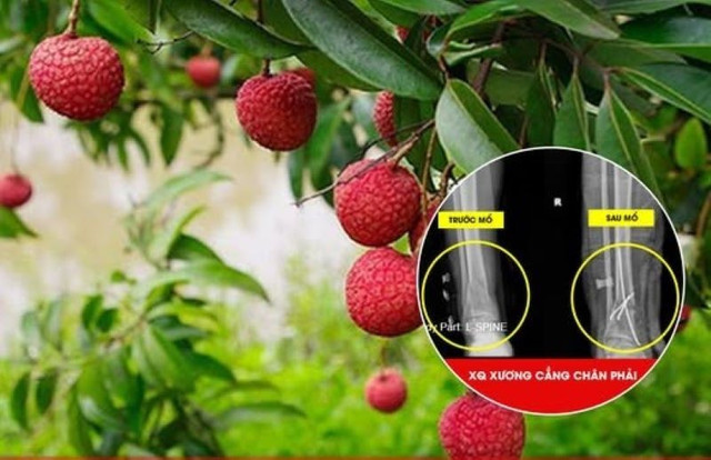 Trèo cây hái vải, người đàn ông bị ngã ông đa chấn thương. da-chan-thuong-vai.jpg