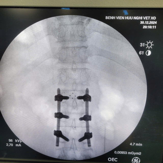 Cột sống được cố định vững - Ảnh BVCC bat-vit-1.jpg