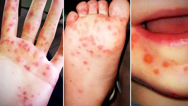Bệnh tay chân miệng gia tăng - Ảnh minh họa BVCC tay-chan-mieng-he.jpg
