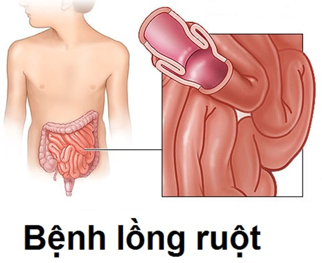 Ảnh minh họa BVCC long-ruot.jpg