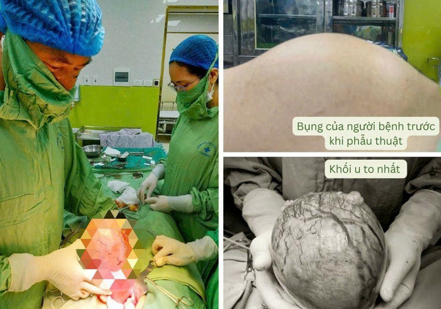 Đa u xơ tử cung kích thước lớn do dùng thực phẩm chức năng - Ảnh BVCC u-xo-tu-cung-1.jpg